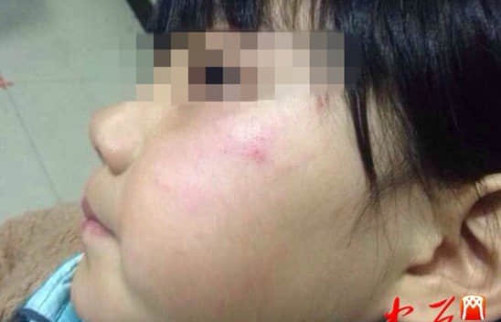 郑州5岁半女童午休不愿脱衣 遭男老师扇脸(图)